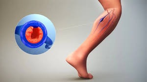 Chronic DVT Treatment: Advanced Options for Long-Term Relief