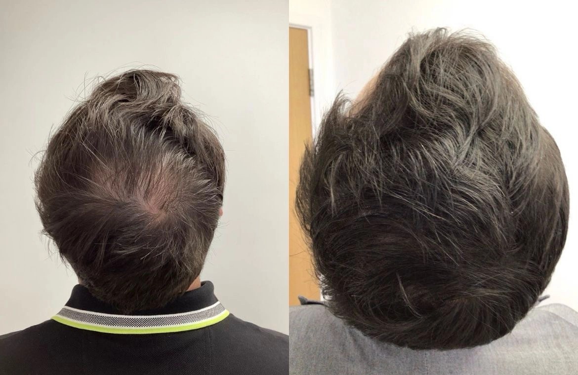 PRP Hair Treatment vs. Hair Transplant: Which One Is Right for You?