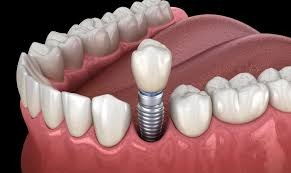 7 Factors That Determine Dental Implant London Aesthetics, According to Leading LondonSpecialists