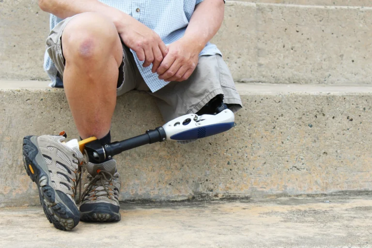 How Much Is a Leg Amputation Worth?