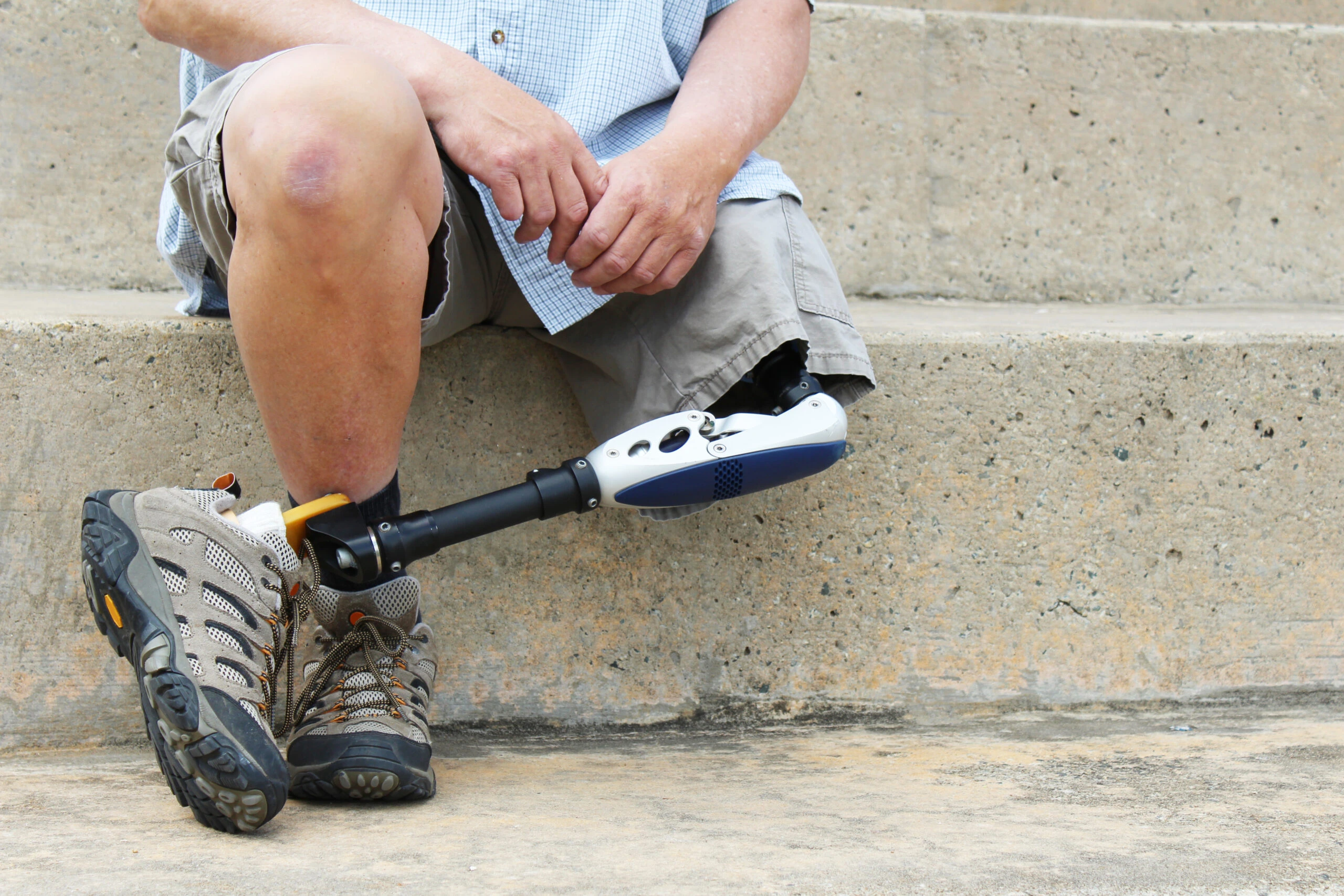 How Much Is a Leg Amputation Worth?